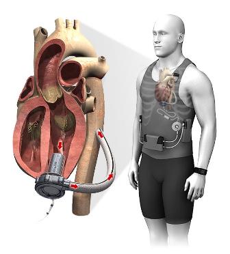Illustration of the Calon Cardio ventricular assist device