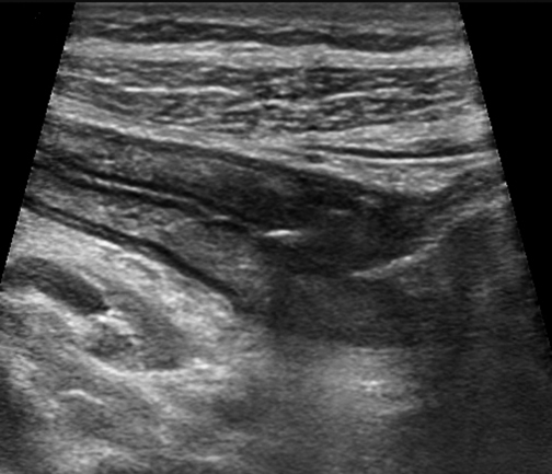 Cross sectional image of the terminal ileum show thickend bo
