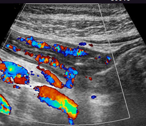 Colour Doppler images showing hyperermia of the bowel