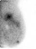 Image taken using breast-specific gamma imaging (BSGI).