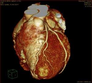 A 3D image of the heart from the Philips Brilliance iCT scanner