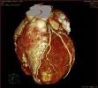 A 3D image of the heart from the Philips Brilliance iCT scanner