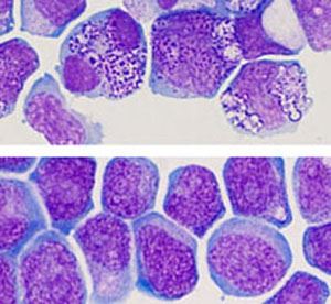 Leukaemia cells grown with and without the new chemicals