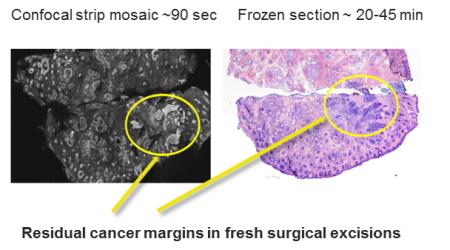 Comparison of residual cancer detected with the new confocal imaging technique and the currently used freezing and staining technique.