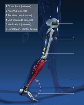 Picture of a model leg illustrating the The ActiGait implant components