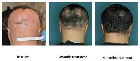 Restored hair growth in a research subject with alopecia areata over 4 months