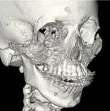 Image of patient's skull after surgery