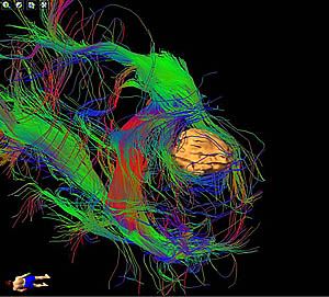 Tractography image showing nerve network around 
			a brain tumour