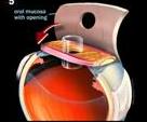 Diagram showing eyetooth implanted in the eye as a base for holding a new lens