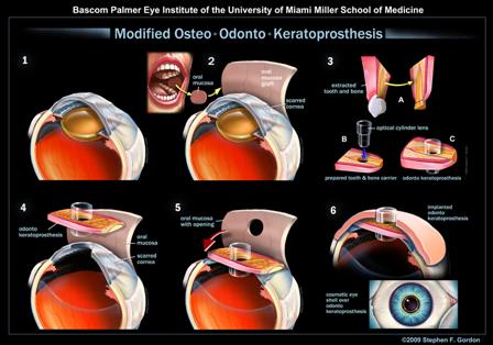 Diagram of modified osteo-odonto-keratoprosthesis