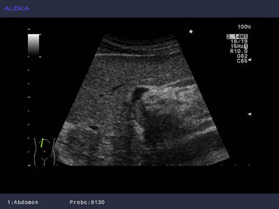 Ultrasound image of hepatocellular carcinoma