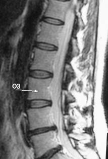 MR image of spine one year after treatment for a herniated disc