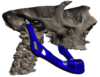 Computer imaging of the jaw fitting to the skull of the patient