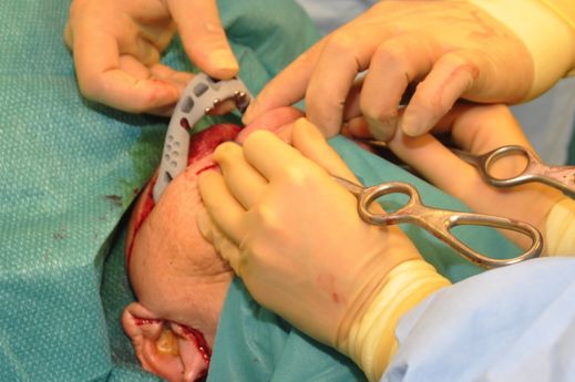 Surgeons placing the jaw in the patient