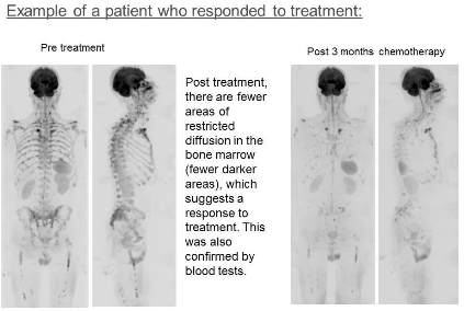 Example of a patient who responded to treatment, showing scan before and after 3 months of treatment, with fewer darker areas in the bone marrow