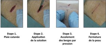 A deep wound is repaired by applying the aqueous nanoparticle solution