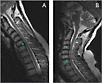 Spinal images taken by the NeuroSwing