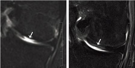 MRI of defect tissue site before (left) and four months after (right) transplantation