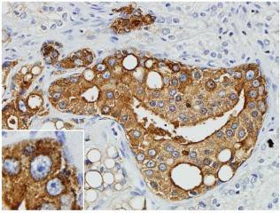 Malignant prostate cancer cells with staining showing presence of viral proteins
