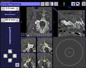 An example of using the new navigation system to plan position of pedicle screws in spinal surgery