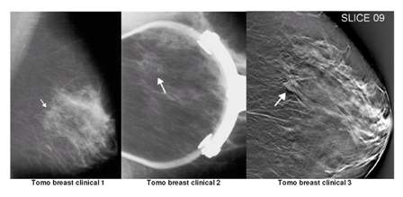 Breast tomosynthesis images from clinical trial at Duke University