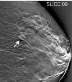 Tomosynthesis image of breast