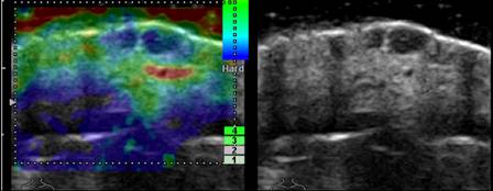 An elastogram (left) and ultrasound image (right) showing squamous cell carcinoma of the skin.