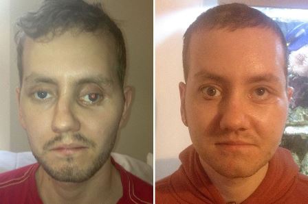 The patient before and after facial reconstruction