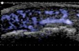 ultrasound image of tendinitis in fingertip
