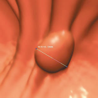 A V3D reconstructed image of a colon